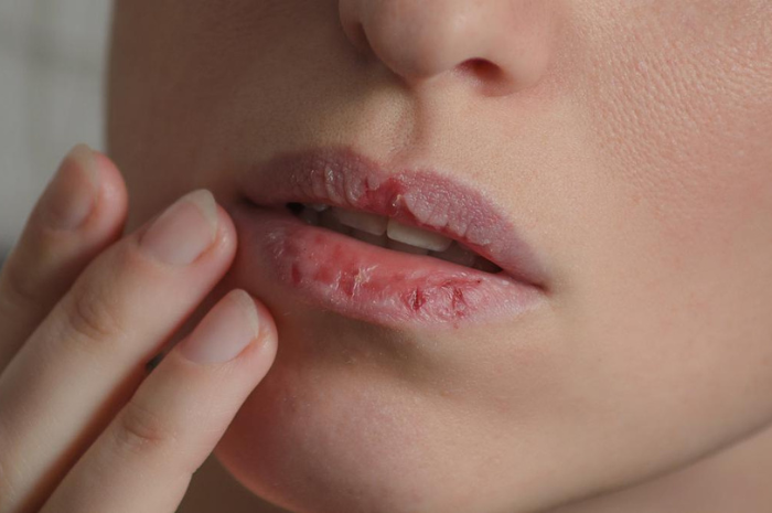 5 Penyebab Bibir Kering dan Pecah-Pecah yang Jarang Disadari oleh Banyak Orang ( Pixabay )