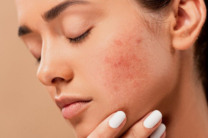 5 cara alami mengatasi kulit kering pada area wajah untuk mendapatkan kulit lebih halus dan kenyal