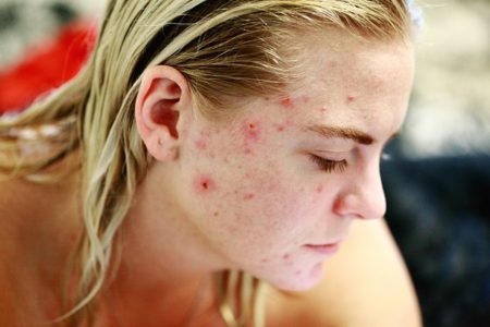 Ini Dia Penyebab Acne Prone Skin dan Cara Ampuh Mengatasinya