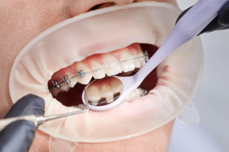Panduan Lengkap Tentang Behel Gigi: Proses Pasang, Perawatan, dan Biaya